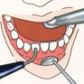 3. 　 歯科医師又は歯科衛生士により、前処置としての機械的歯面清掃が行われます。
