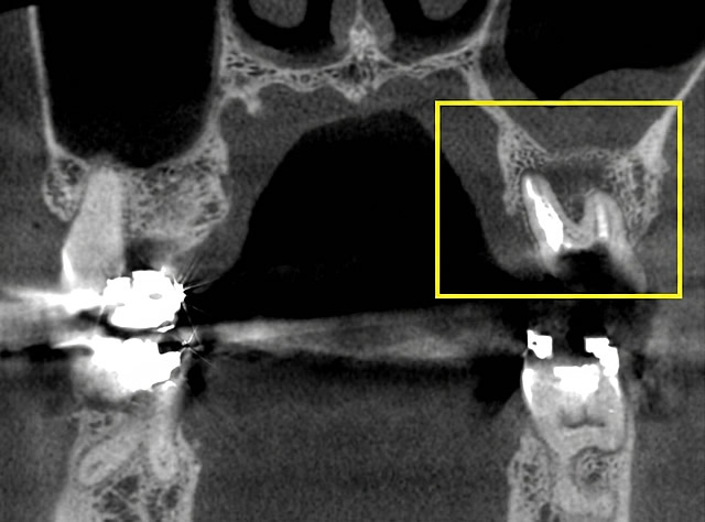 歯科用CT レントゲン装置