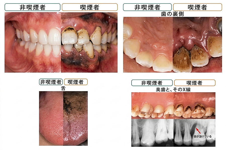 非喫煙者と喫煙者の比較