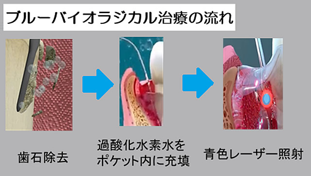 ブルーバイオラジカル治療の流れ