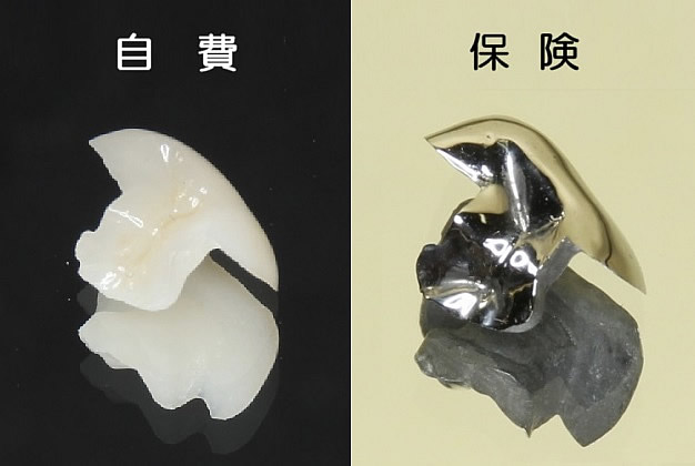 歯の素材